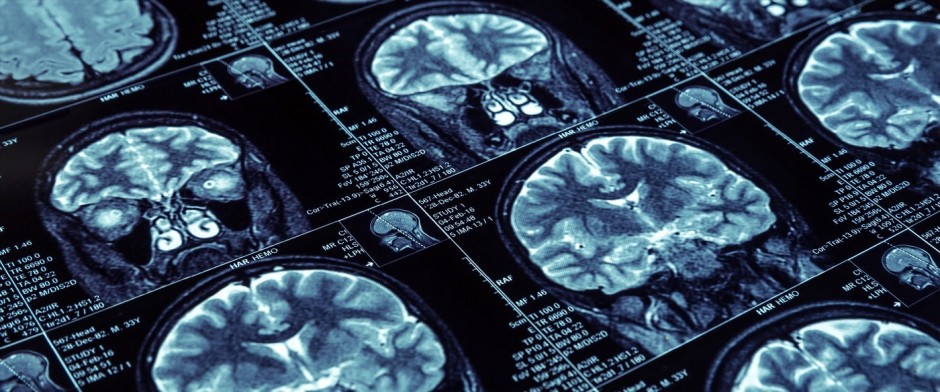 Resonancia Magnética: Un reto para el diagnóstico y seguimiento de la Esclerosis Múltiple